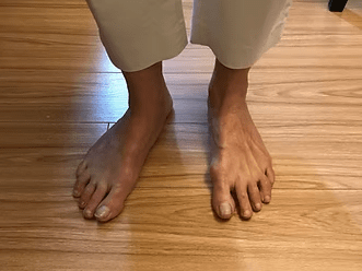 Pied droit dévié avant intervention